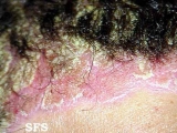 psoriasis