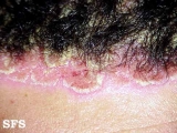 psoriasis