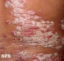 psoriasis