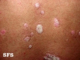 psoriasis