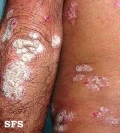 psoriasis