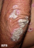 psoriasis