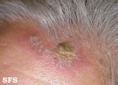 psoriasis