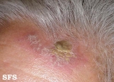 psoriasis