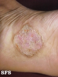 psoriasis