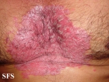 psoriasis