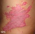 psoriasis