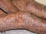 psoriasis