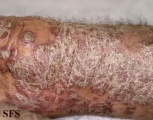 psoriasis