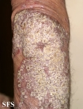 psoriasis