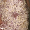 psoriasis