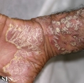 psoriasis