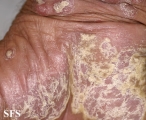 psoriasis