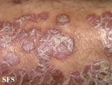 psoriasis