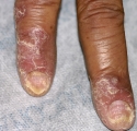 psoriasis