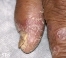 psoriasis