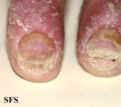 psoriasis