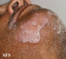 psoriasis