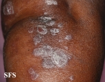 psoriasis