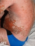 psoriasis