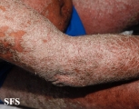 psoriasis