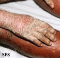 psoriasis