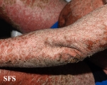 psoriasis