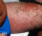 psoriasis