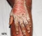 psoriasis