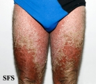 psoriasis