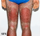 psoriasis