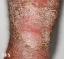 psoriasis