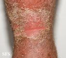 psoriasis