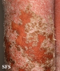 psoriasis