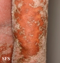 psoriasis