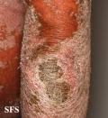 psoriasis