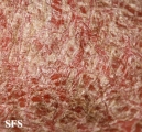 psoriasis