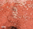 psoriasis