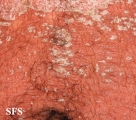 psoriasis