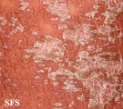 psoriasis