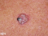 spiradenoma