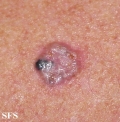 spiradenoma