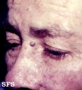 spiradenoma