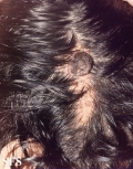 syringocystadenoma papiliferum