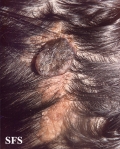 syringocystadenoma papiliferum