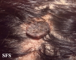 syringocystadenoma papiliferum