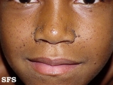 tuberous sclerosis