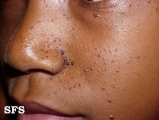 tuberous sclerosis