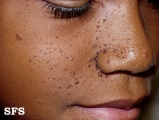 tuberous sclerosis