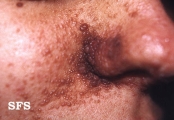 tuberous sclerosis
